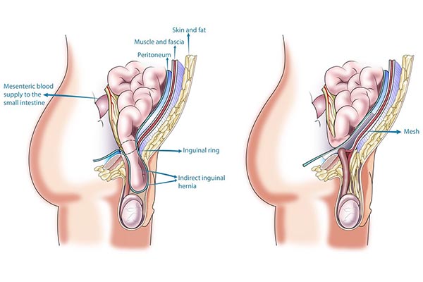 OPEN-HARNIA-GENERAL-SURGERY