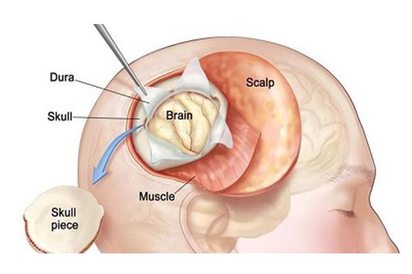 neurosurgery