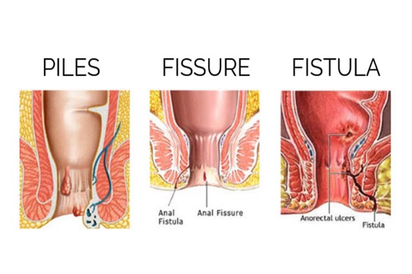 open-anorectal-surgery