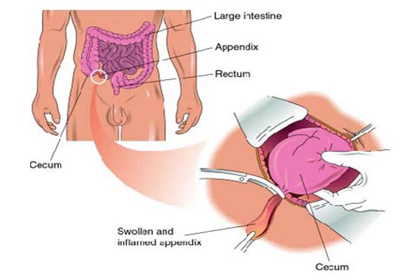 open-appendectomy-general-surgery